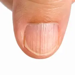 Sådan redder du dine beskadigede negle